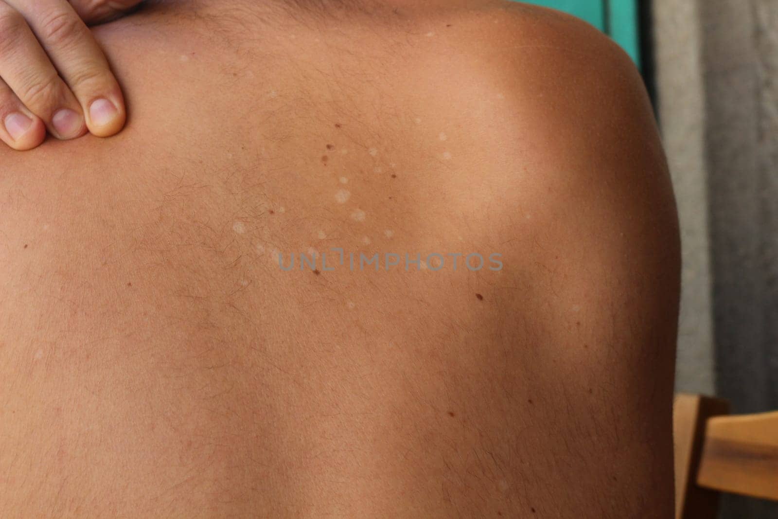 Explore the nuances of Tinea Versicolor, also known as pityriasis versicolor, a common fungal infection affecting the skin