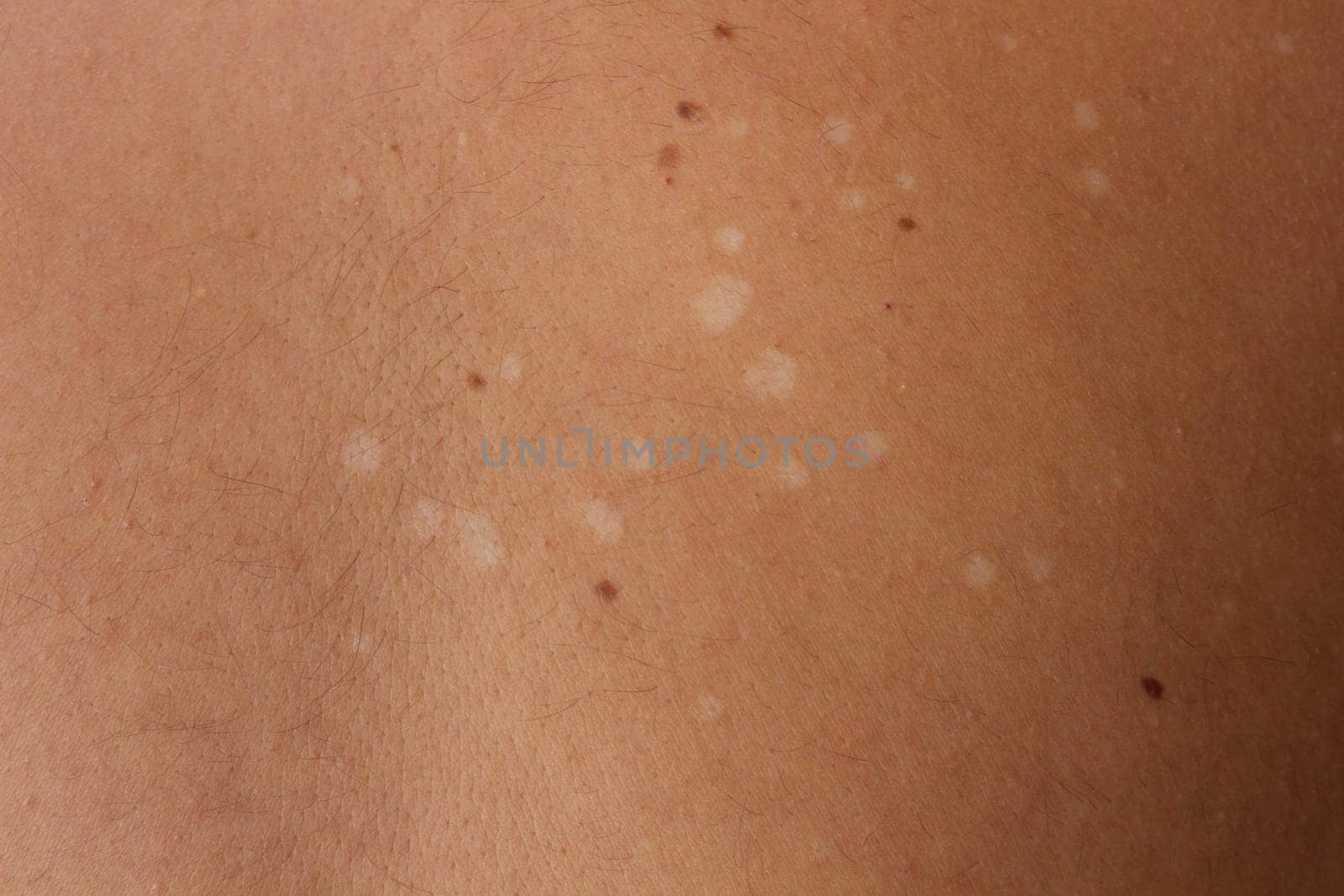 Explore the nuances of Tinea Versicolor, also known as pityriasis versicolor, a common fungal infection affecting the skin