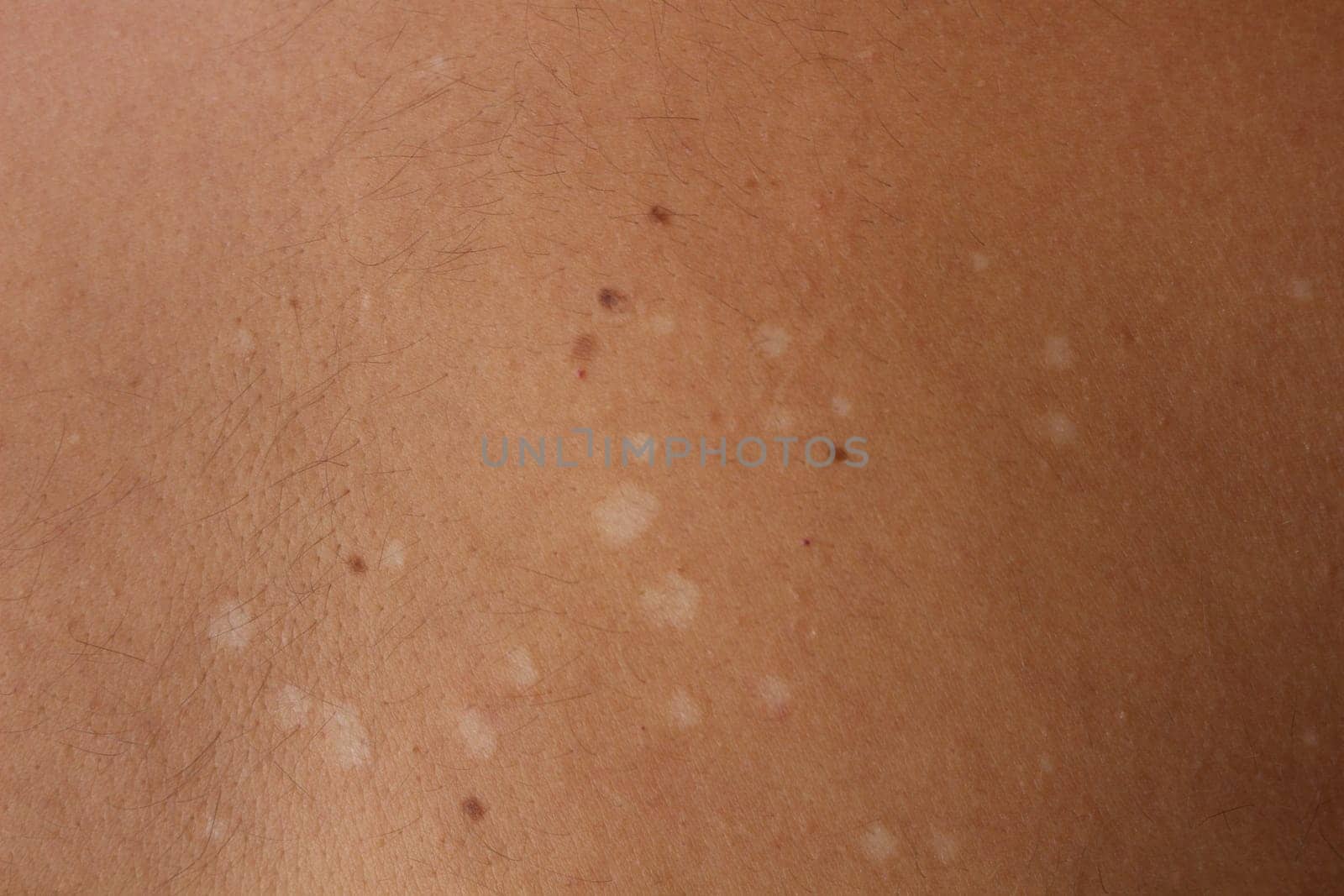 Understanding Tinea Versicolor: Managing and Treating Pityriasis Versicolor by DakotaBOldeman