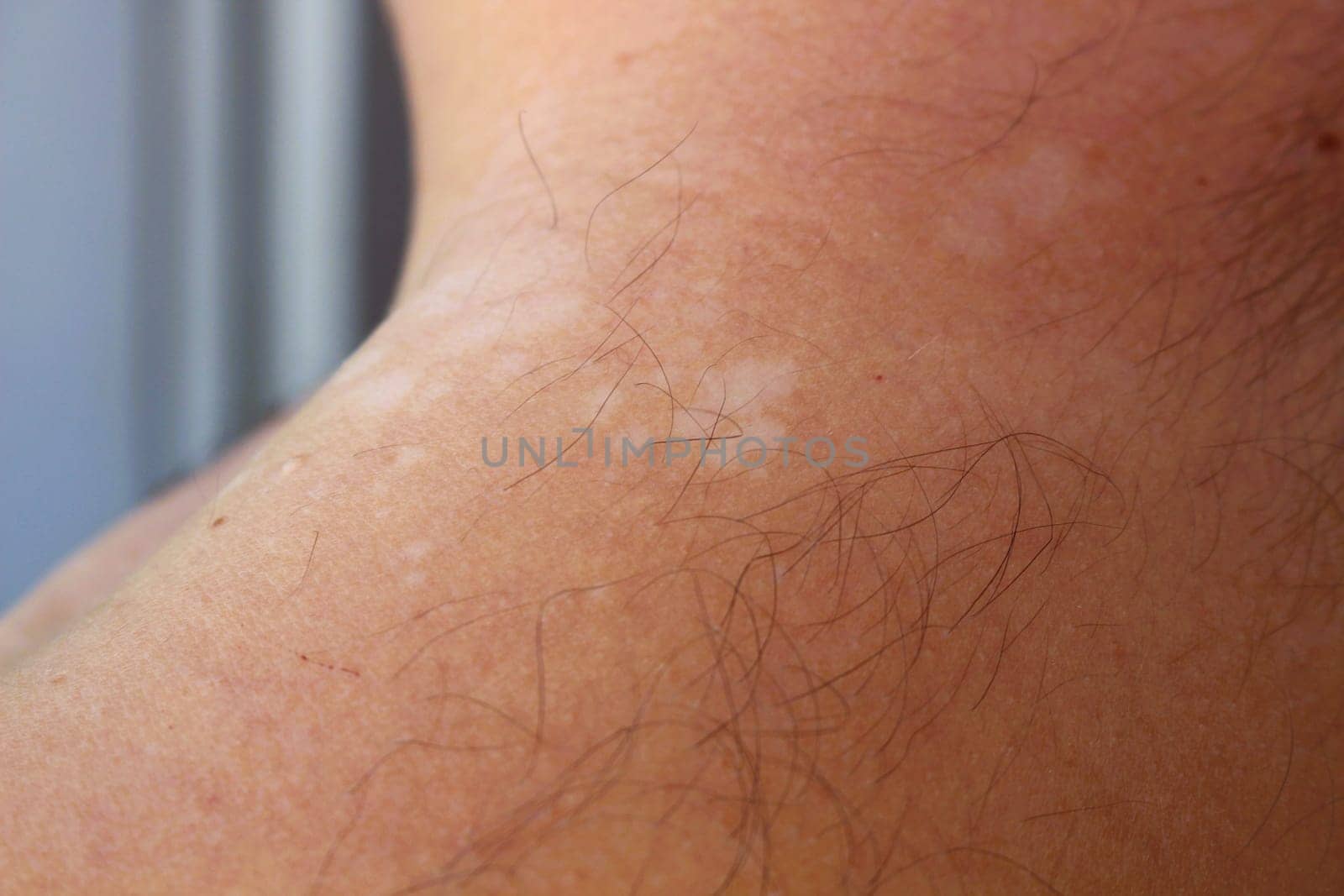 Understanding Tinea Versicolor: Managing and Treating Pityriasis Versicolor by DakotaBOldeman