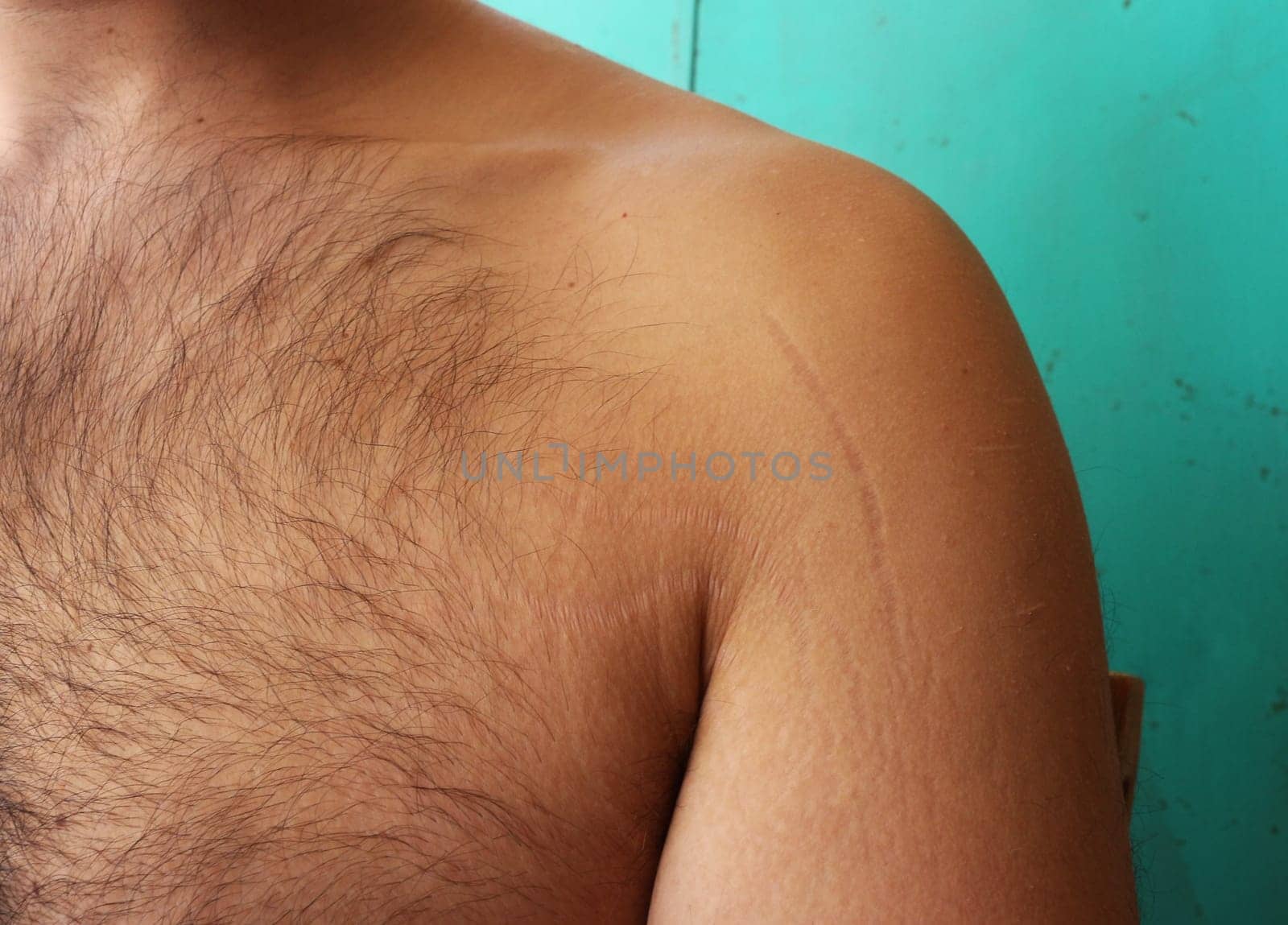 self-acceptance and care as you explore the topic of stretch marks on a man's arms and chest