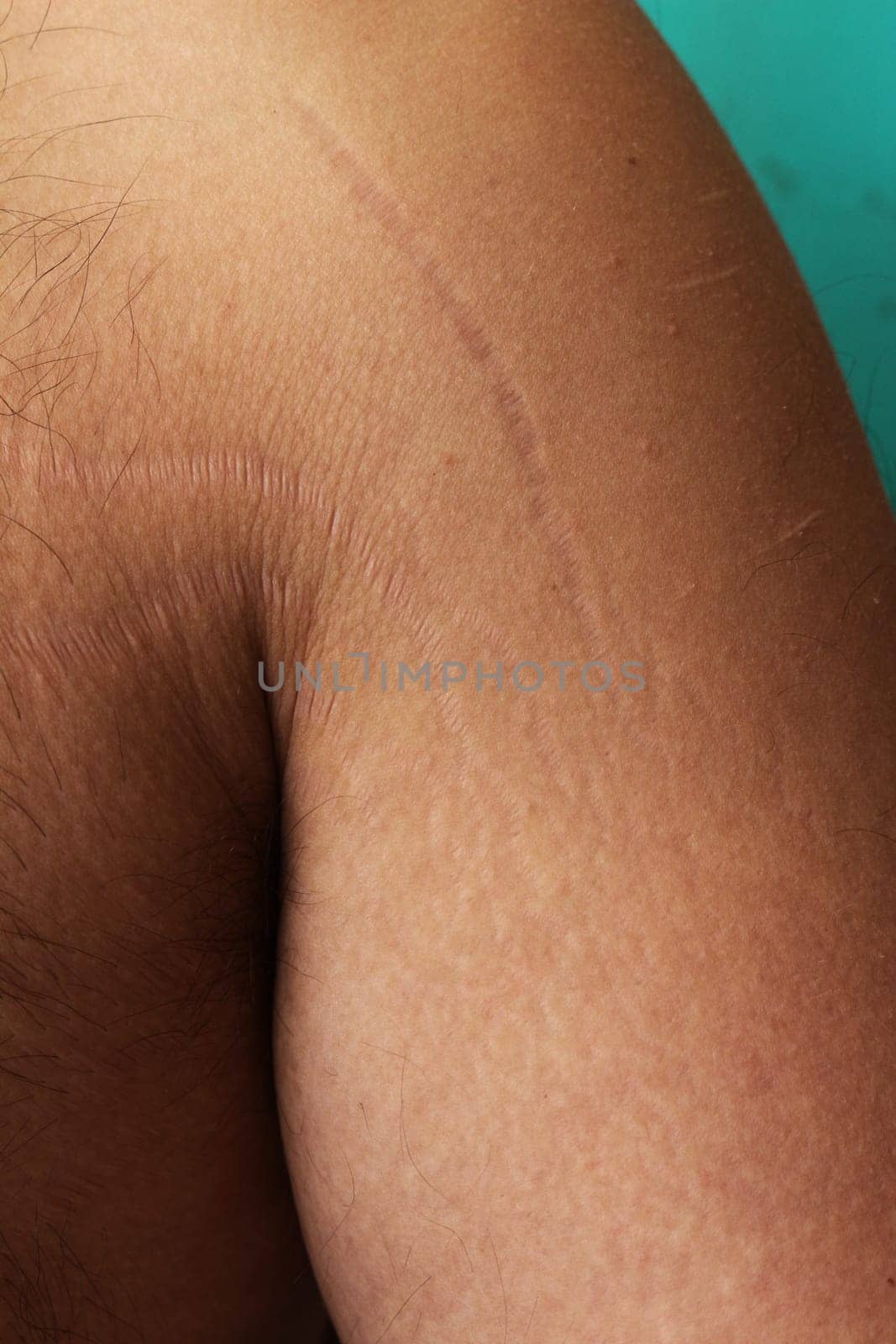 Embracing Change: Understanding and Treating Stretch Marks on Male Arms and Chest by DakotaBOldeman