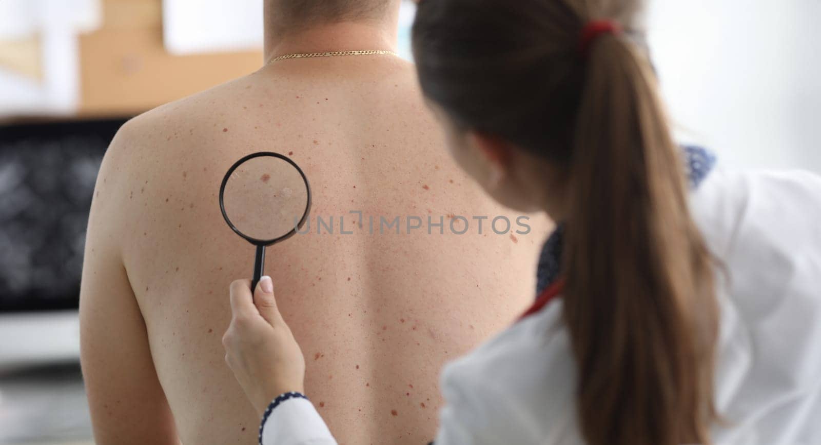 Oncologist holds magnifying glass in hand and examines pigmented nevi on patient's back in clinic. Diagnosis of malignant skin tumors concept.