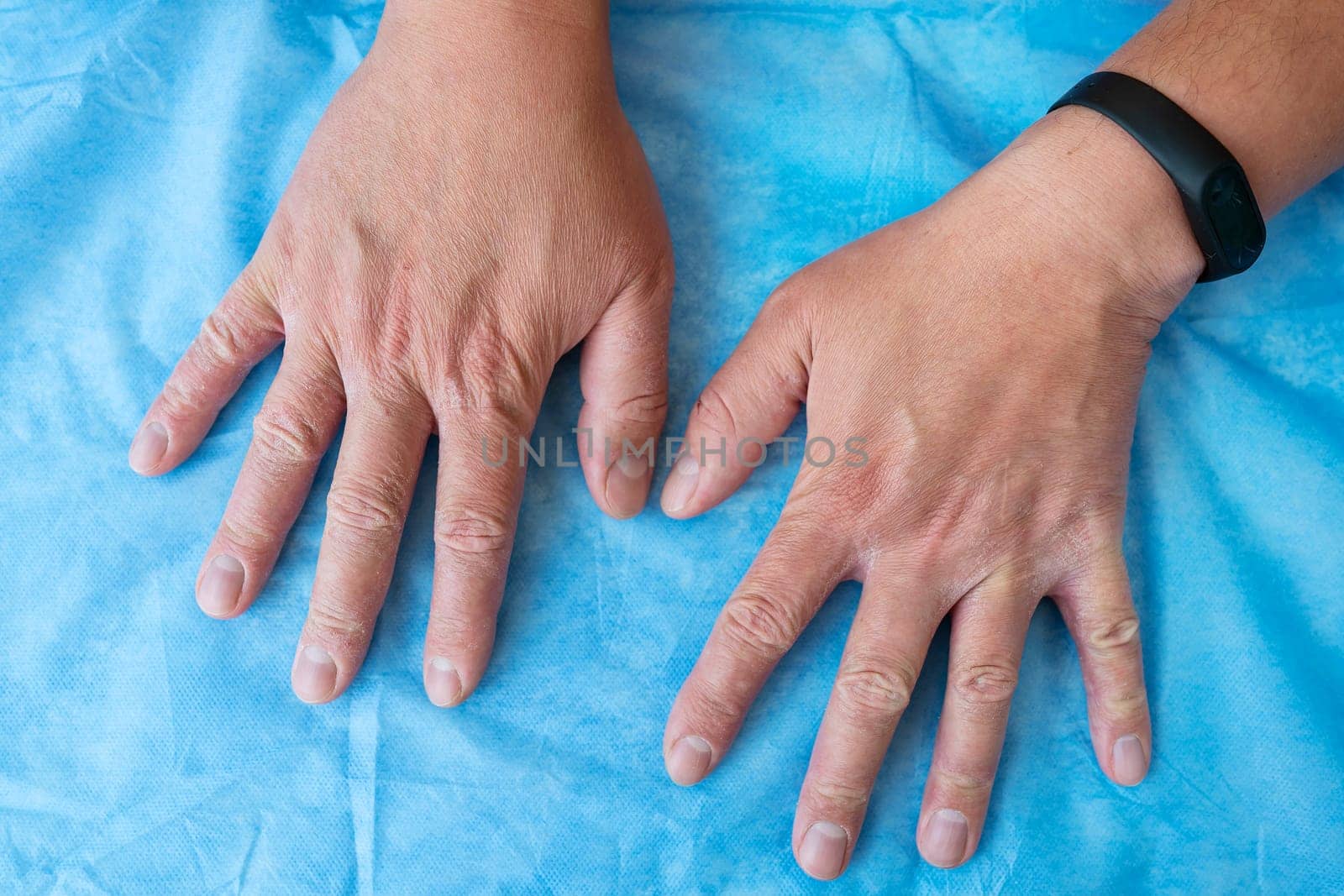 Close-up of hands with very bad skin condition, cracked skin on hands on a blue background. Dermatitis, psoriasis