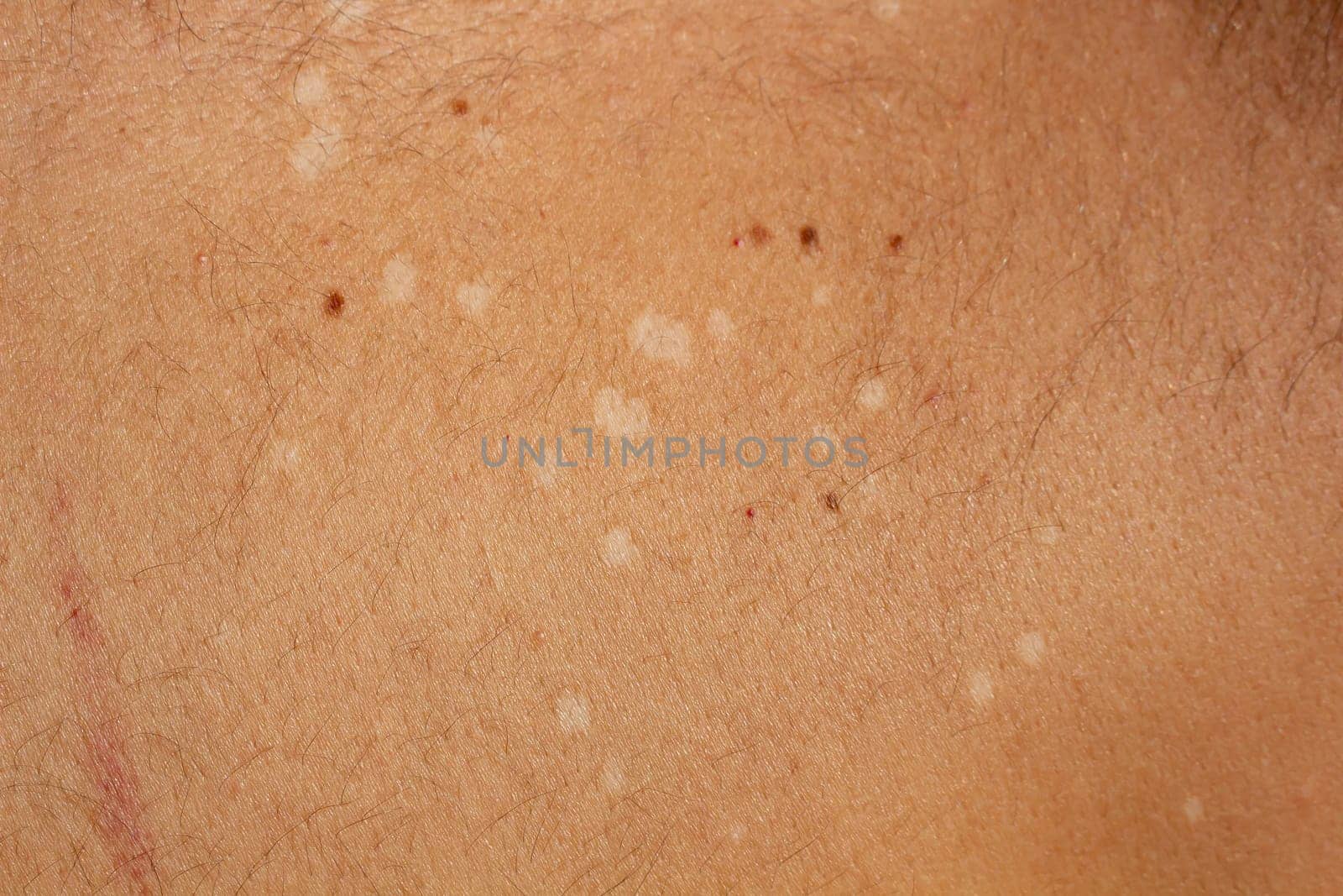 Capture the visual complexity of tinea versicolor, a common fungal skin infection, with this high-resolution stock image