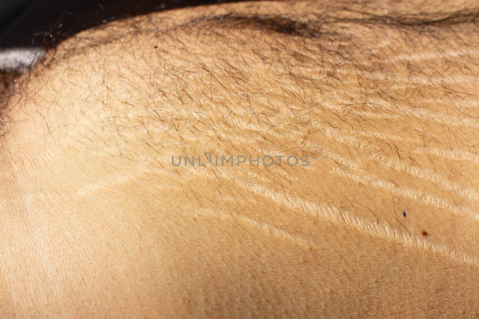 Explore the impact of weight changes, including obesity and muscle gain, on the male body through this compelling stock image capturing stretch marks