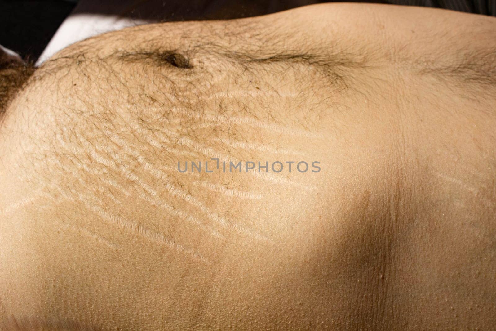 Male Body: Stretch Marks and Weight Changes by DakotaBOldeman