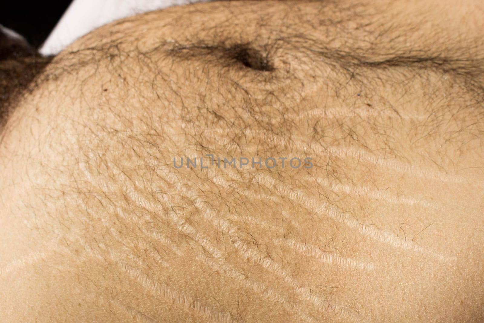 Explore the impact of weight changes, including obesity and muscle gain, on the male body through this compelling stock image capturing stretch marks