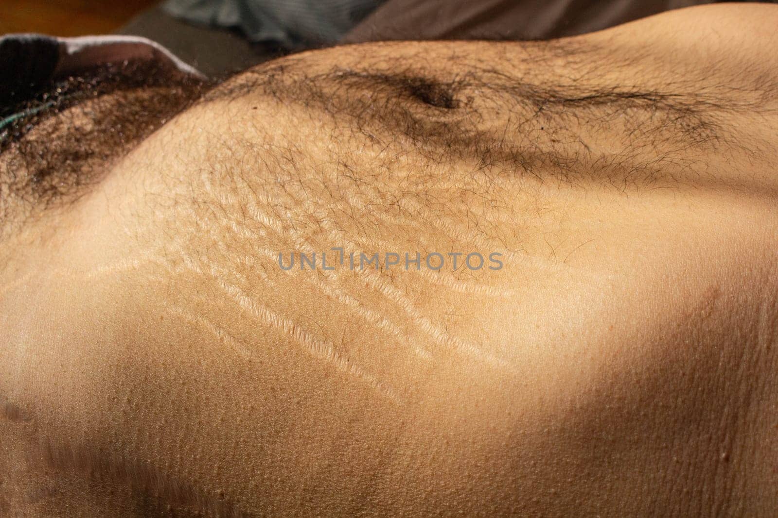 Explore the impact of weight changes, including obesity and muscle gain, on the male body through this compelling stock image capturing stretch marks