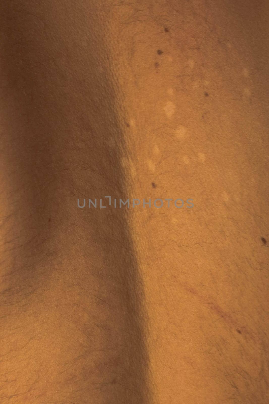 Skin Condition: Tinea Versicolor. Lack of pigmentation by DakotaBOldeman