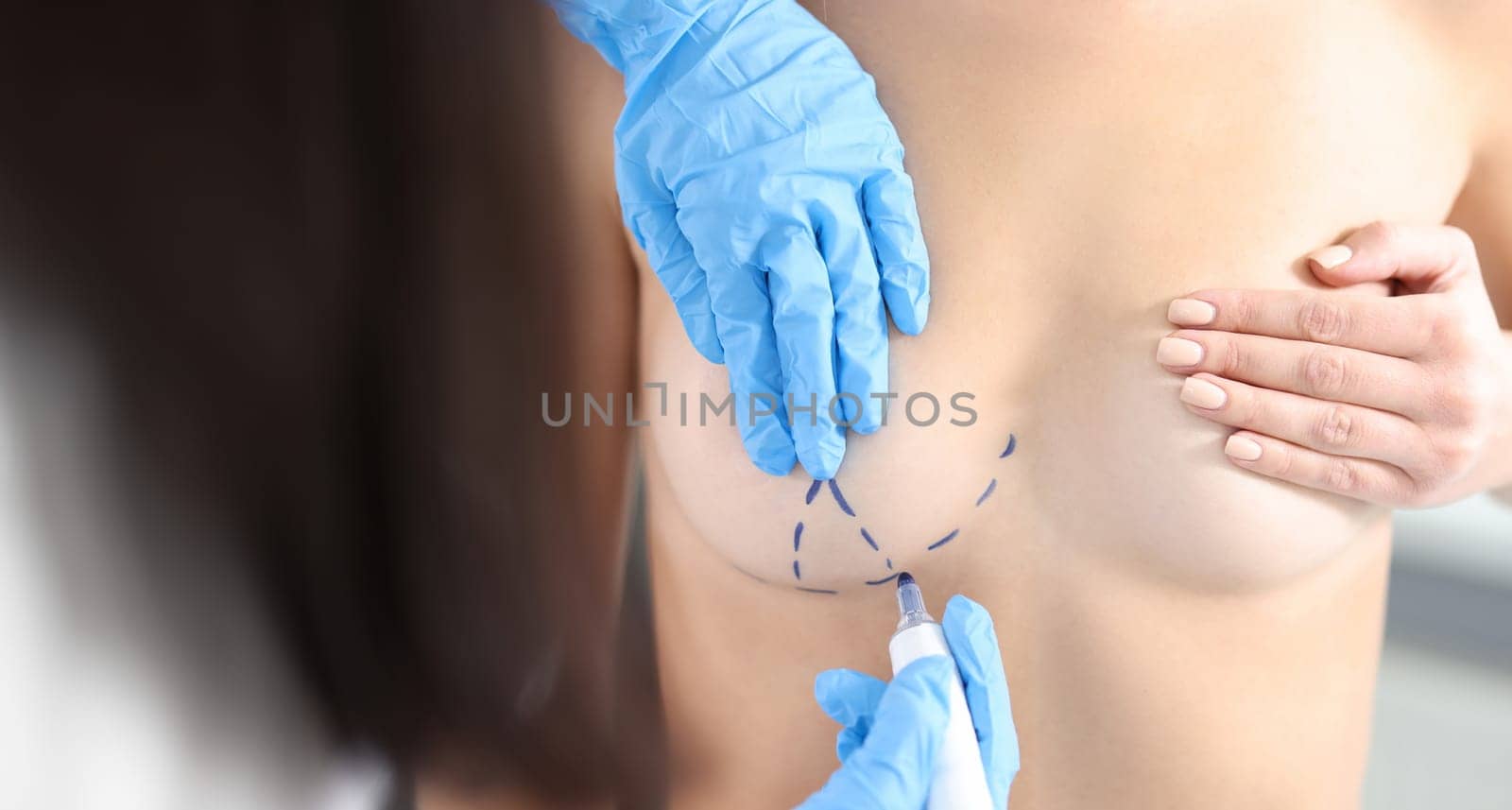 Plastic surgeon drawing preoperative markings on patient chest closeup. Breast augmentation surgery concept