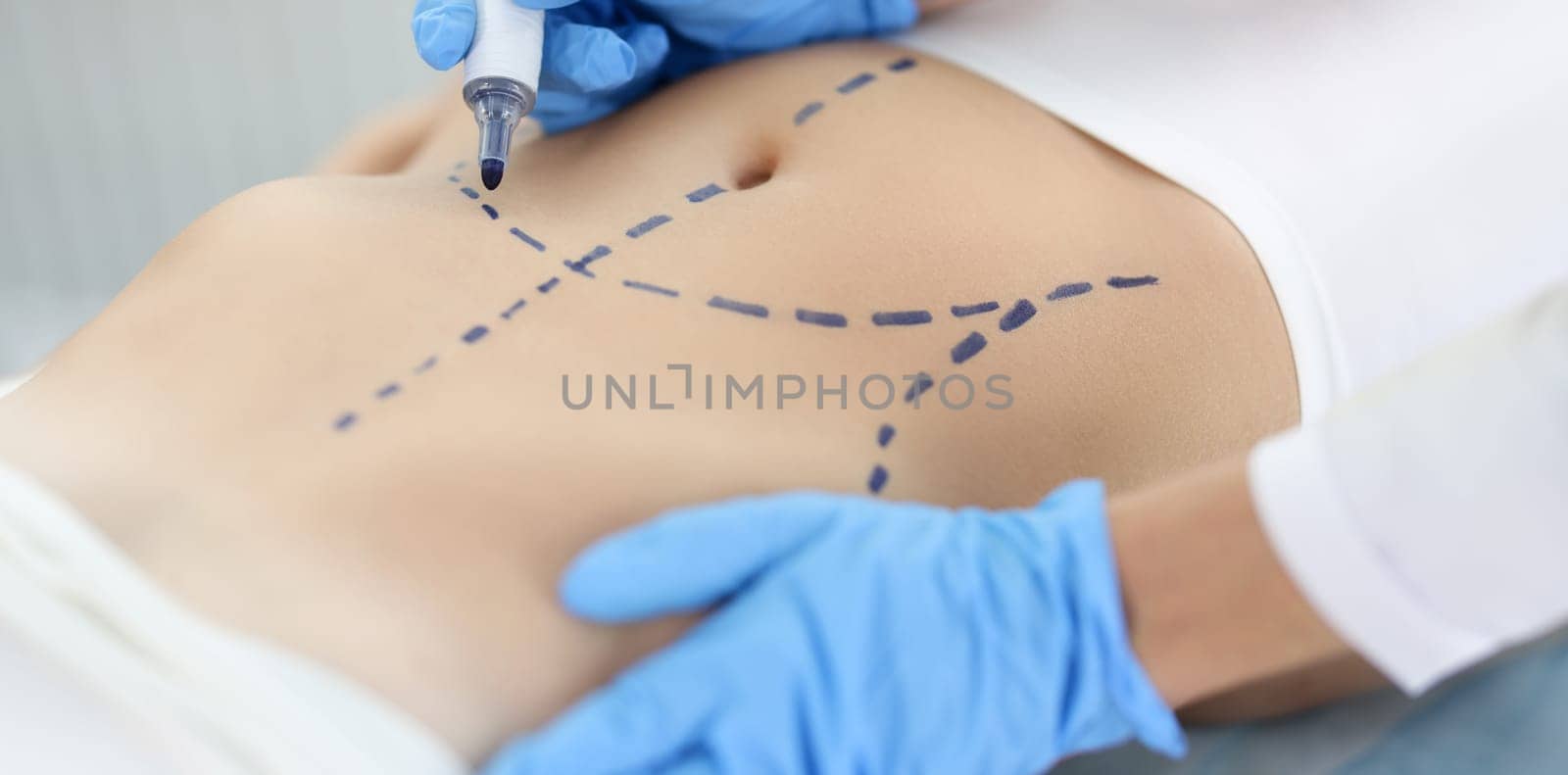 Doctor plastic surgeon drawing preoperative markings on skin of patient abdomen closeup by kuprevich