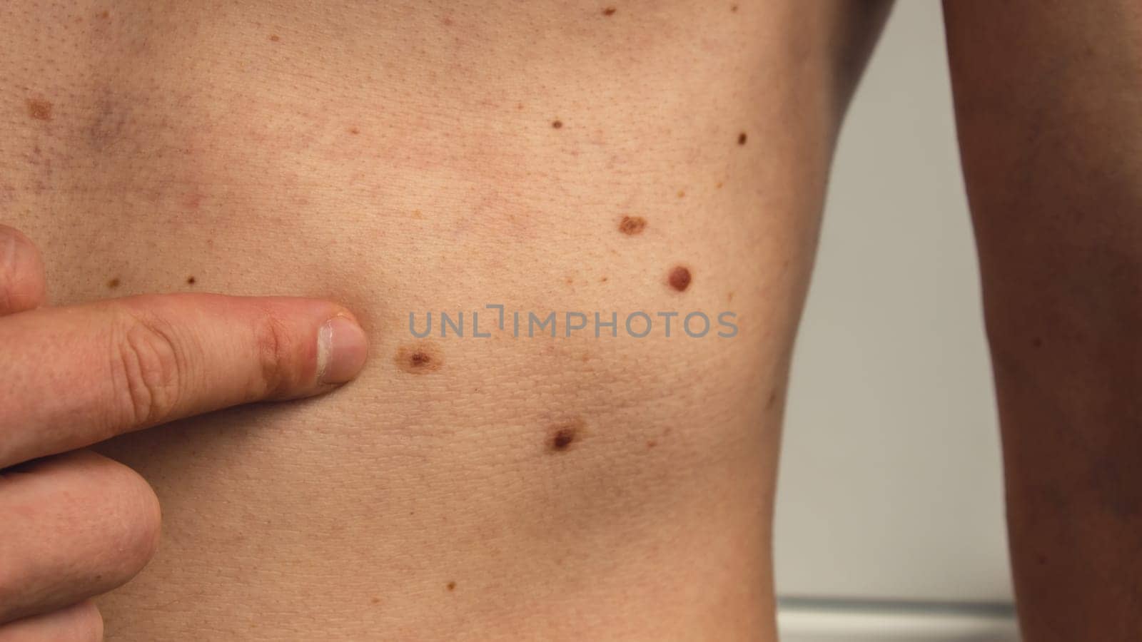 Male hand showing birthmarks on skin body stomach part. Close up detail of the bare skin. Health Effects of UV Radiation. Man with birthmarks Pigmentation by anna_stasiia