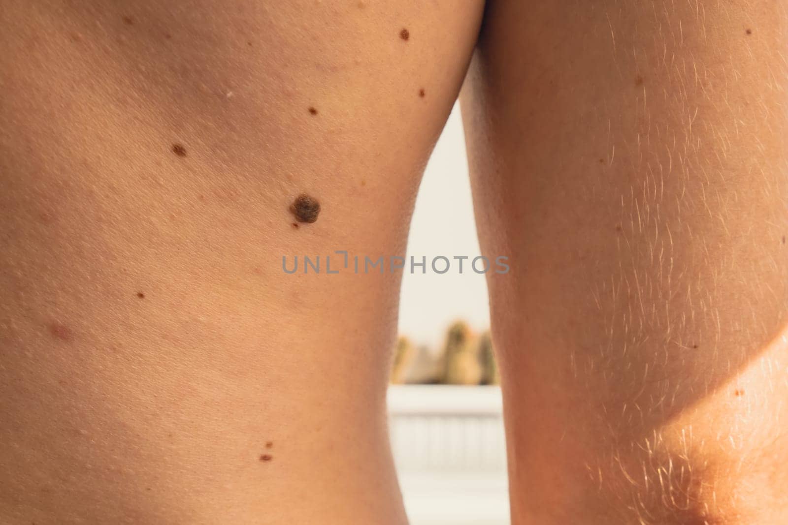 Male showing birthmarks on skin body back part. Close up detail of the bare skin. Health Effects of UV Radiation. Man with birthmarks Pigmentation by anna_stasiia