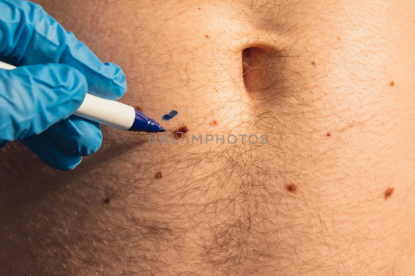 Preparing procedure for medical skin surgery. Unrecognizable Doctor in medical gloves paint lines around male birthmarks. Laser skin tags removal. Prevention of melanoma and nevus exam. Pigmentation