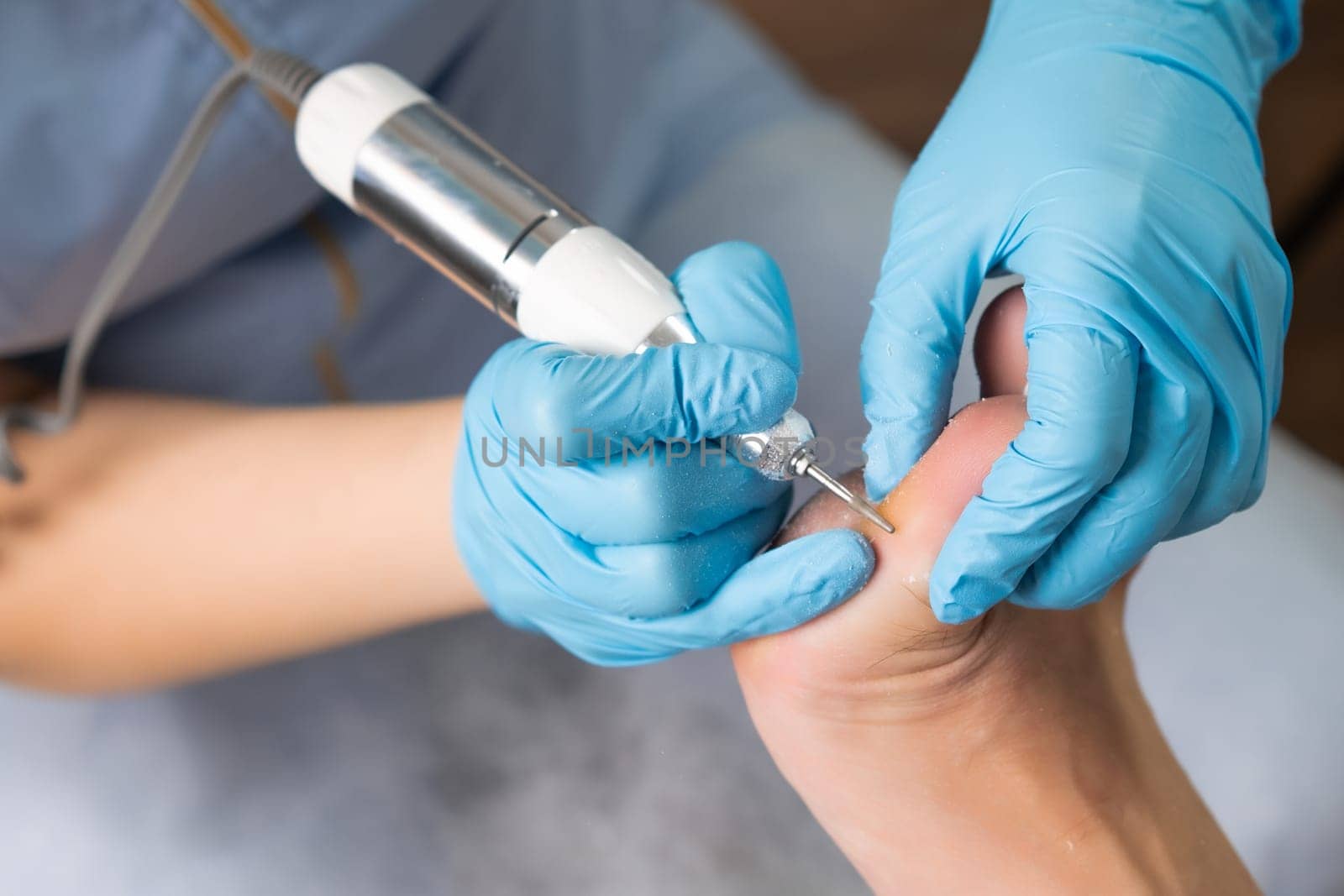 A callus on a womans foot is removed by a podologist using an electric drill at the clinic.