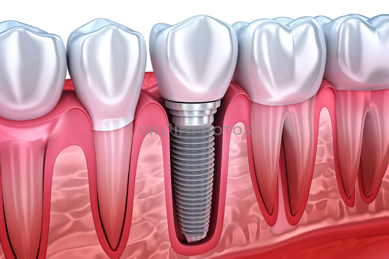 Dental Implant Procedure Implant Supported Teeth. Generative AI by matamnad