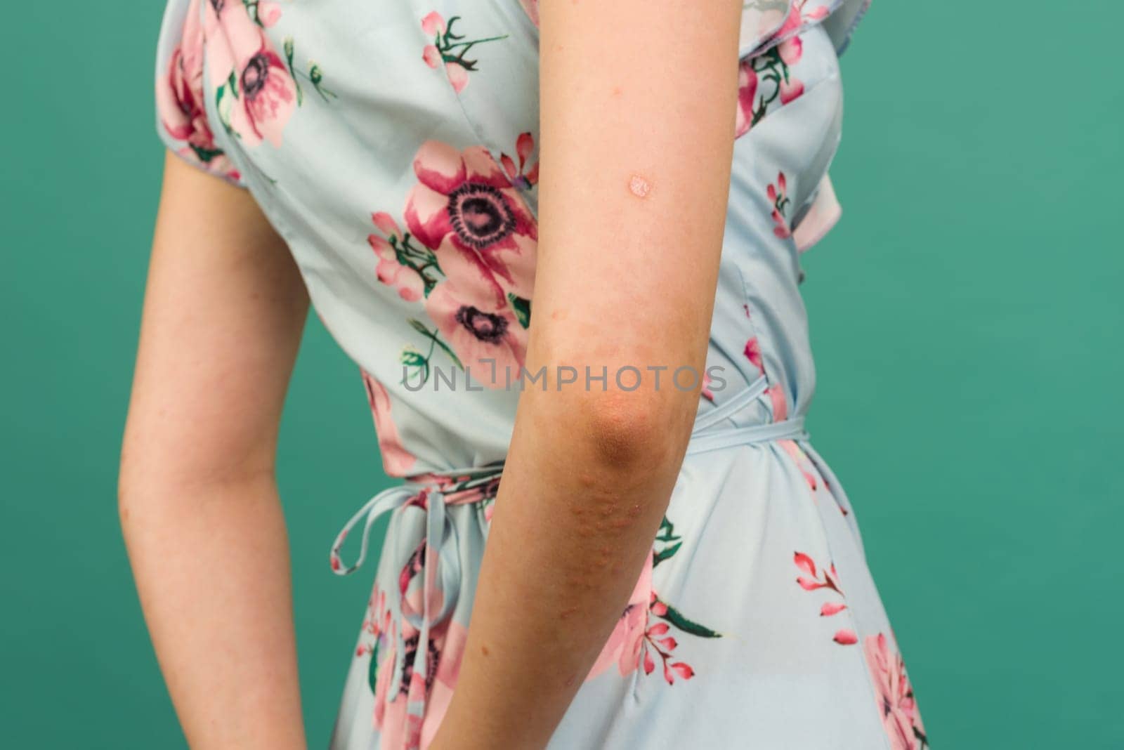 CLOSE UP: Unrecognizable young woman suffering from autoimmune incurable dermatological skin disease called psoriasis. Red, inflamed, scaly rash on elbows. Psoriatic arthritis