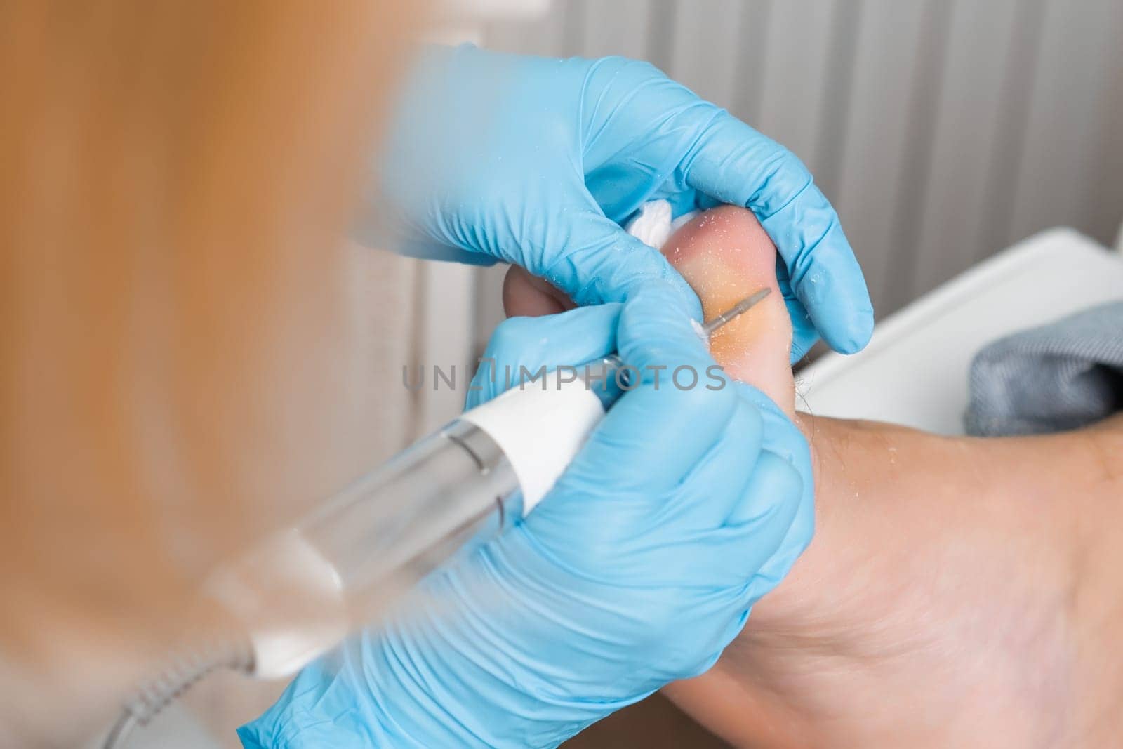 Podologist removes a callus on a patients toe.