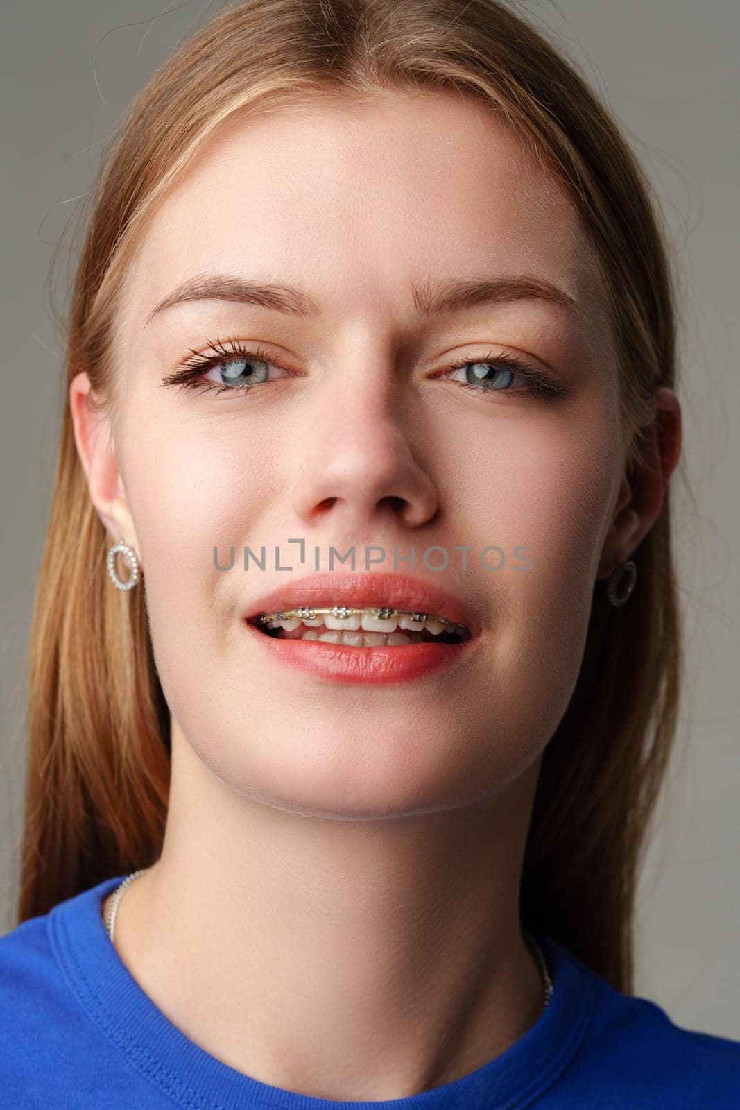 Young woman with dental braces close up by Fabrikasimf