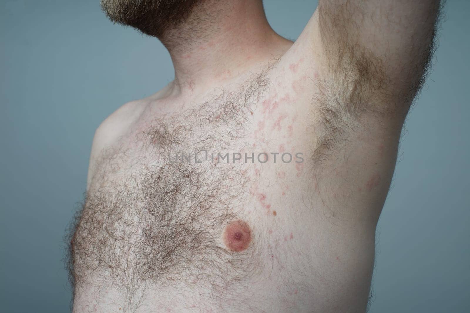 Allergy reaction is red spots on the body of a young man. Urticaria