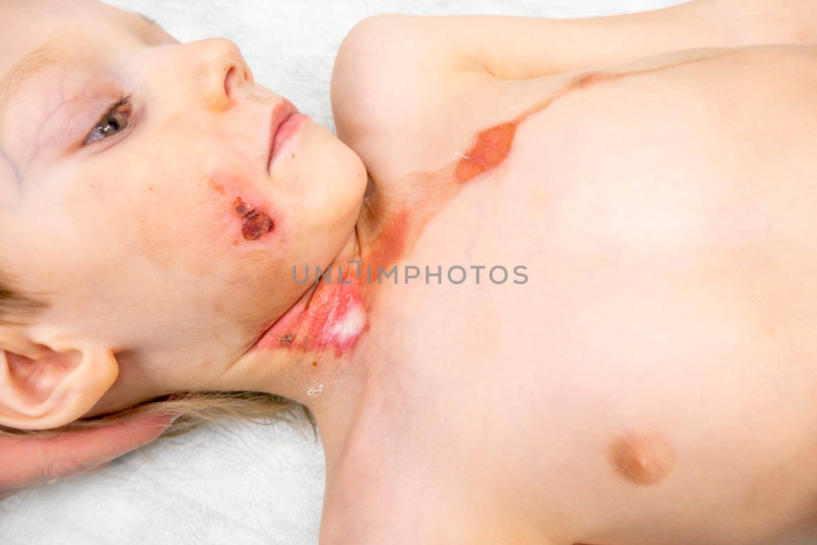 medical procedure dressing a boy with a first-degree burn from boiling water on his face, neck and chest