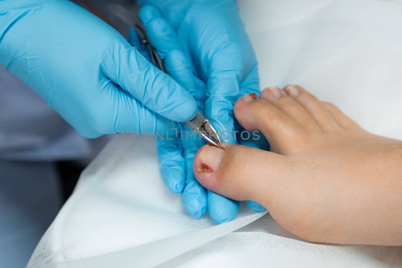 A podiatrist performs the procedure of ingrown nail removal using nippers.