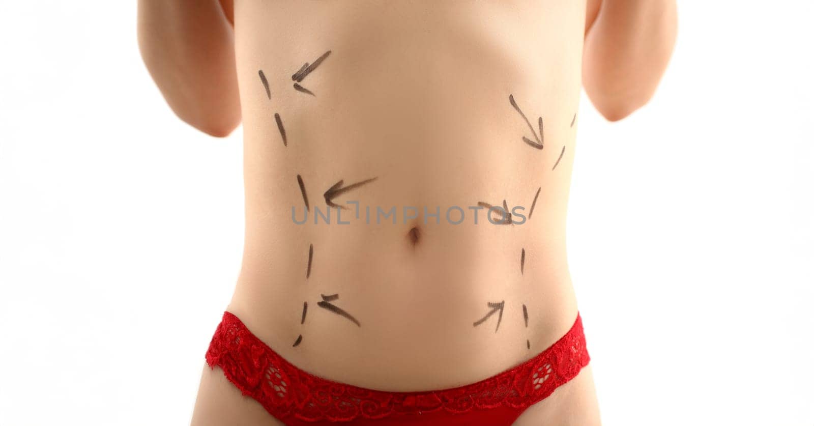 Female body with markup before liposuction by kuprevich