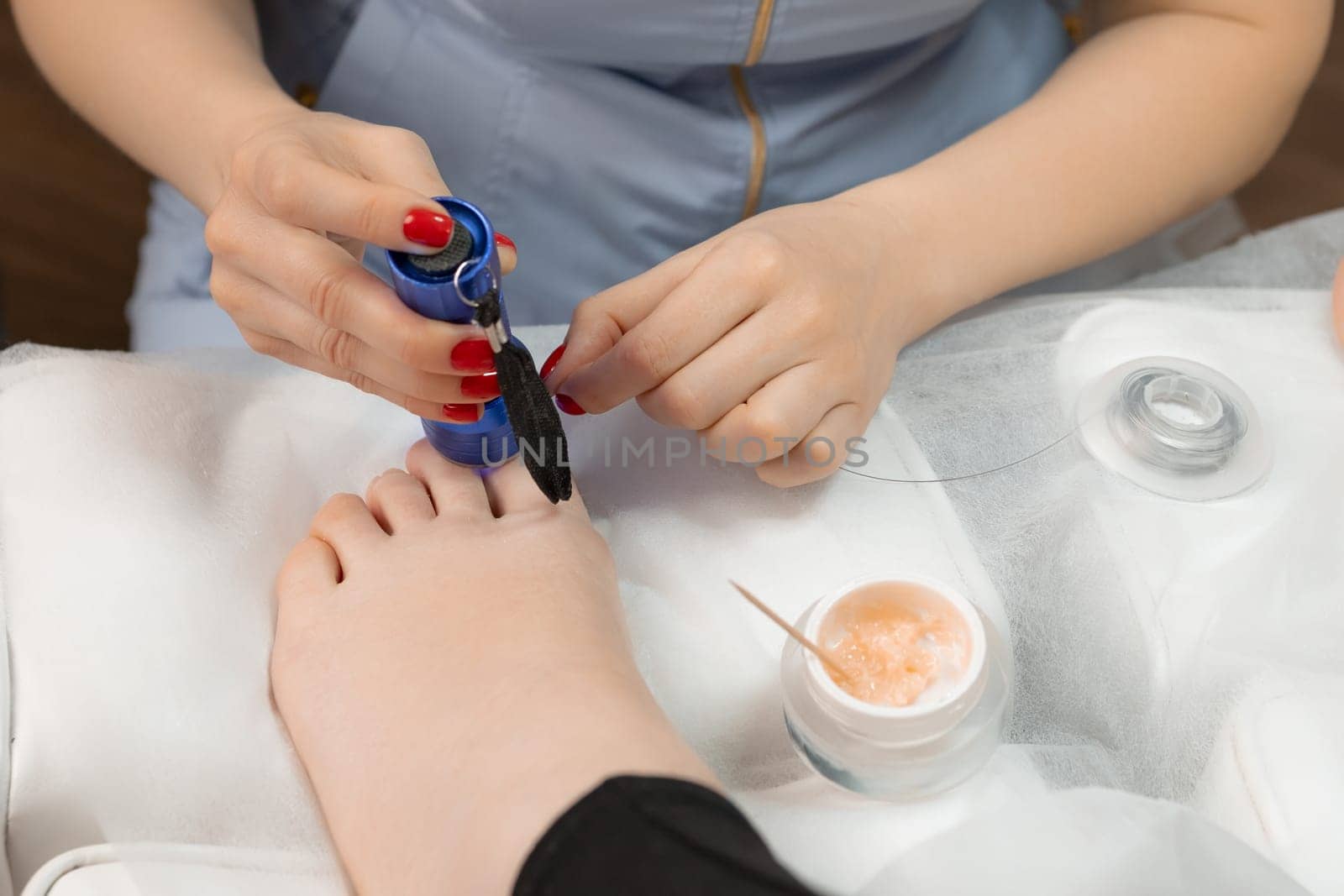 Titanium thread for medical treatment on a toenail installs for woman by podologist by vladimka