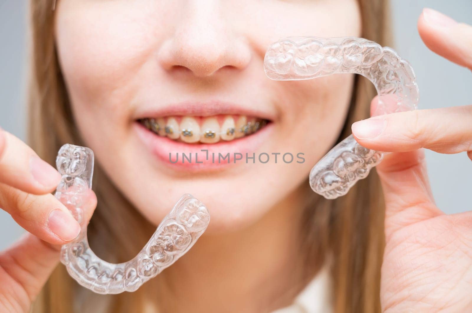 Woman with braces on her teeth holding and removable transparent aligners