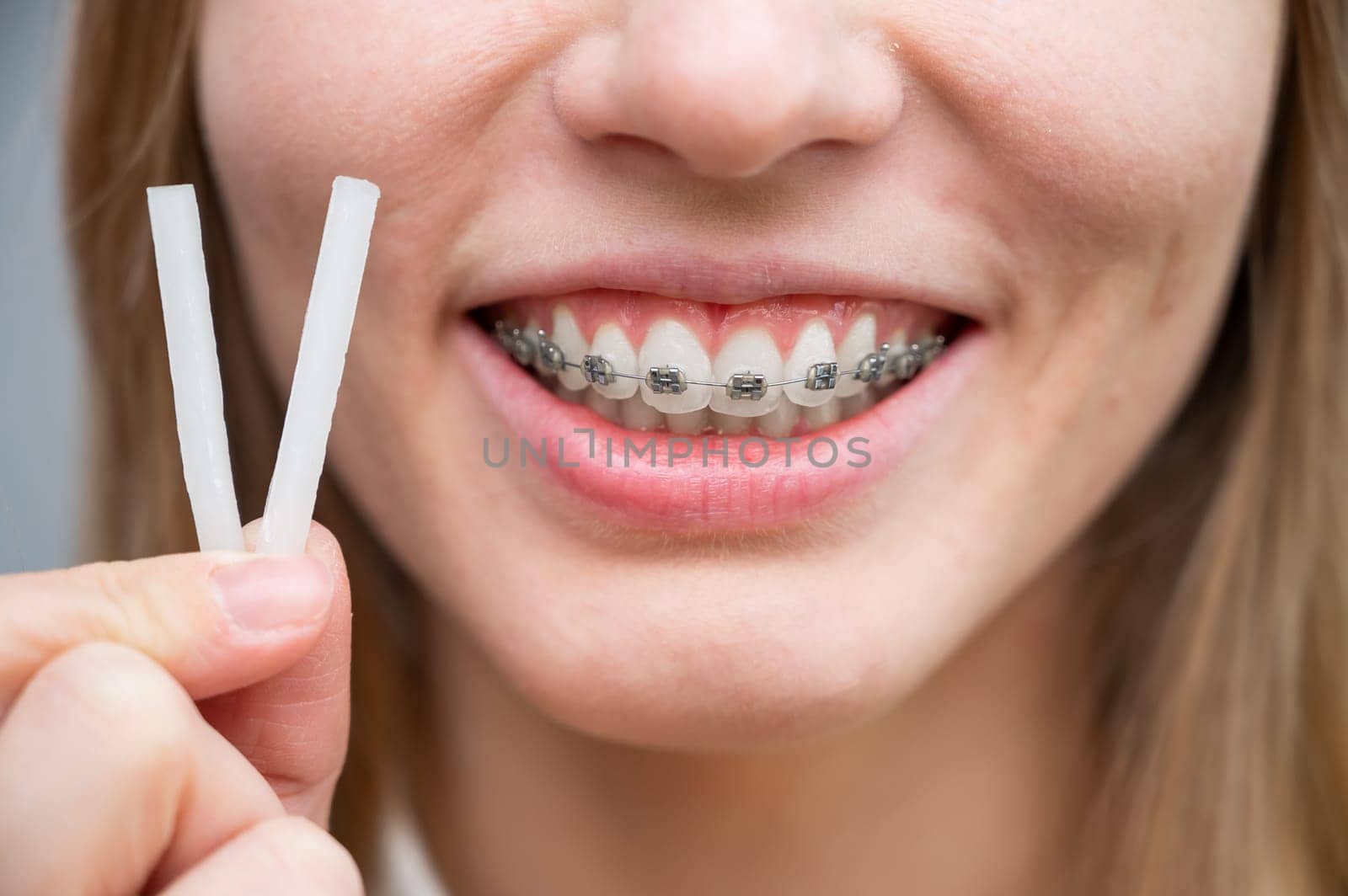 Close-up portrait of a woman with braces using special orthodontic wax