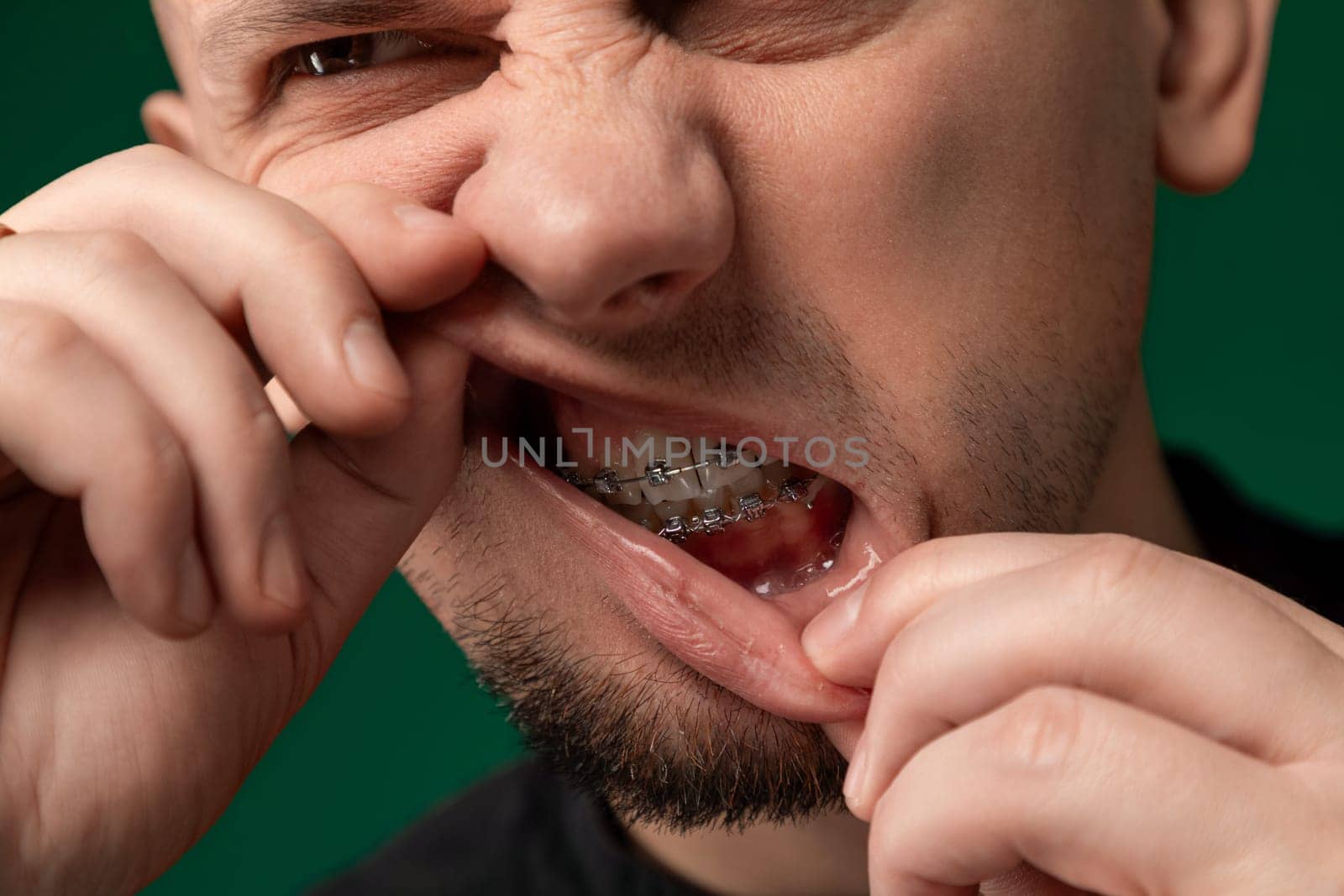 Man With Braces Holding Thumb to Mouth by TRMK