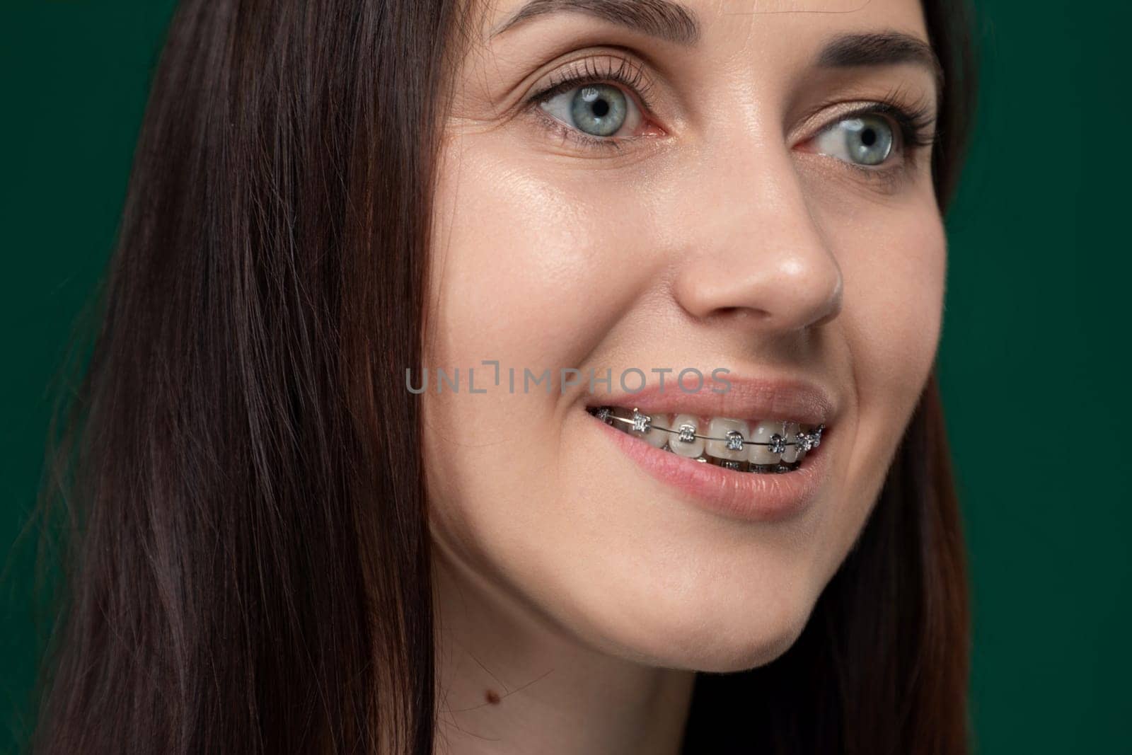 A woman with braces on her teeth smiling cheerfully, displaying her orthodontic treatment. Her teeth are noticeably straighter and aligned, showcasing the effectiveness of braces in improving dental alignment and aesthetics.