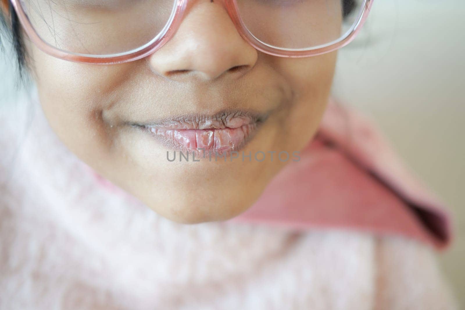 close up of dry lip of a child by towfiq007