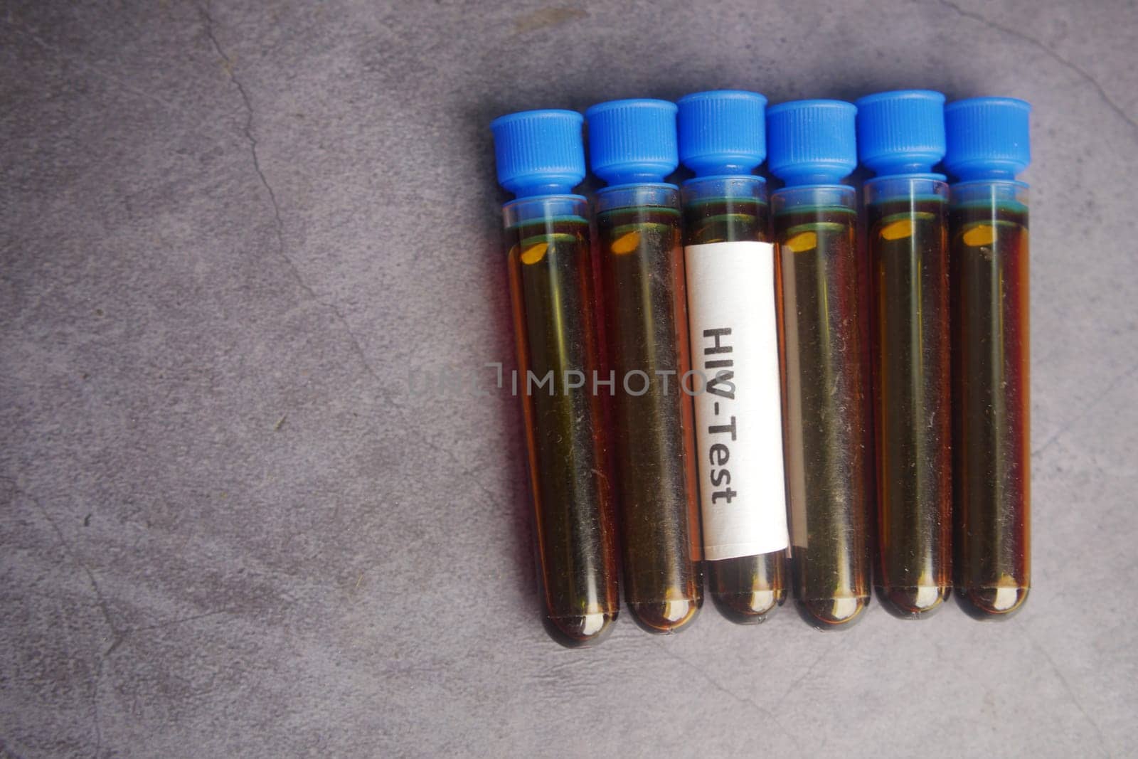 HIV blood test tube on black background by towfiq007