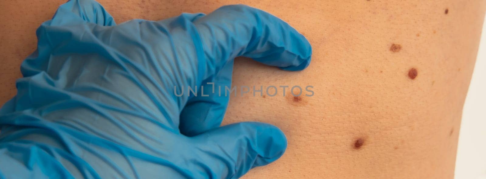 Dermatologist checking male birthmarks for changing size. Annual rechecking. Doctor in medical gloves examining man skin mole. Self care preventing cancer procedure. Protection treatment. Imperfection by anna_stasiia