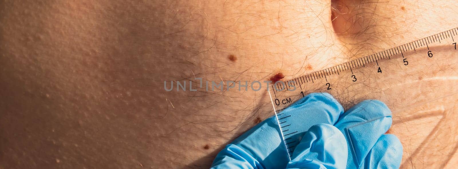 Unrecognizable Doctor in medical gloves examining length and width of benign moles on man skin. Dermatologist checking male birthmarks with ruler by anna_stasiia