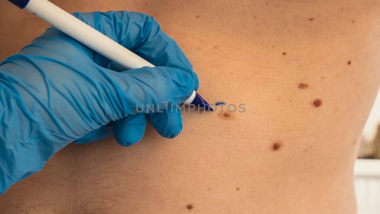 Doctor in medical gloves paint lines around male birthmarks. Preparing procedure for medical surgery. Laser skin tags removal. Prevention of melanoma by anna_stasiia