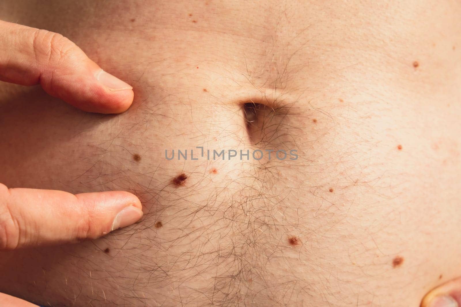 Unrecognizable man showing his birthmarks on skin Close up detail of the bare skin Sun Exposure effect on skin. Health Effects of UV Radiation Male with birthmarks Pigmentation and lot of birthmarks