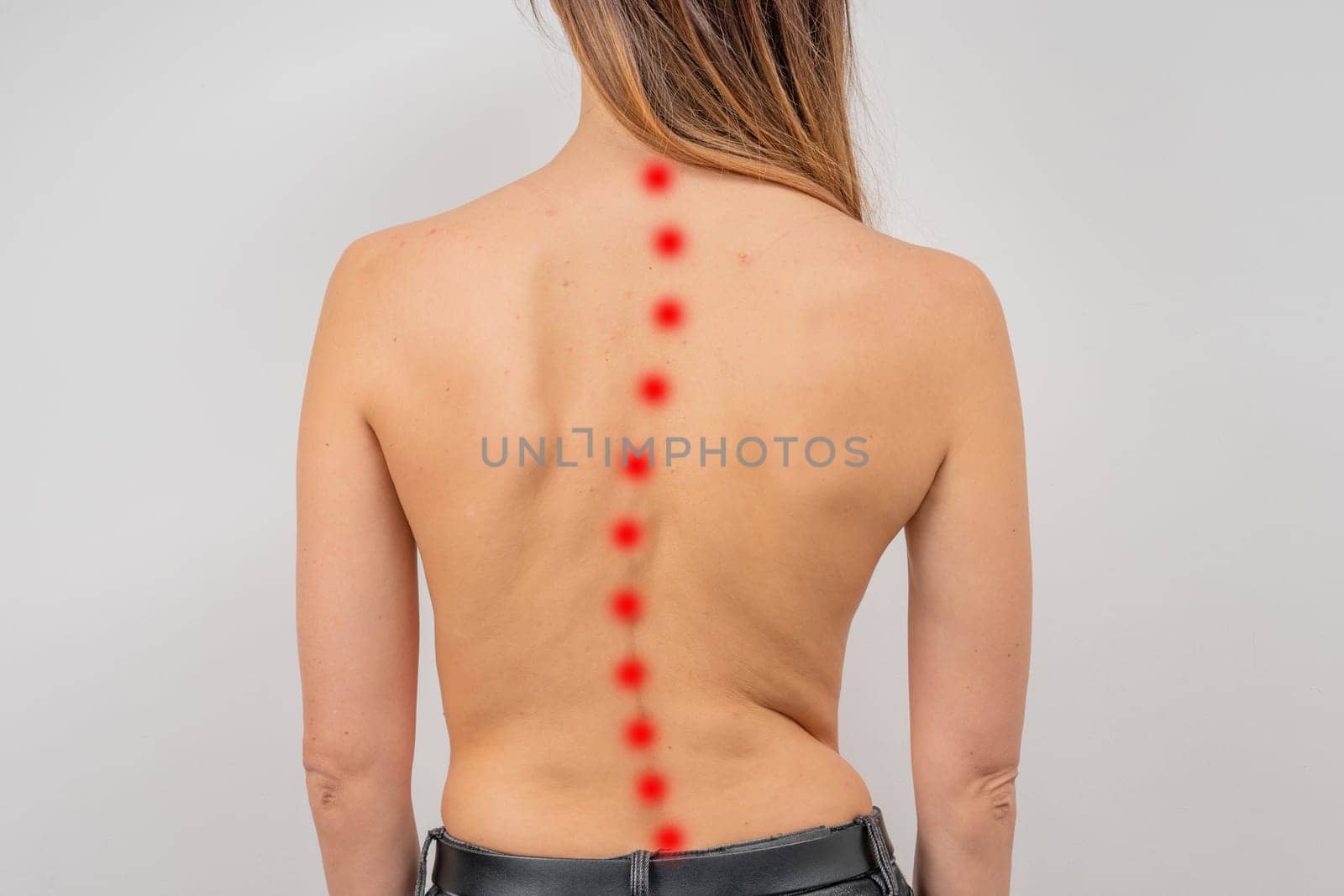 Woman with scoliosis of the spine. Curved woman's back with acne skin.