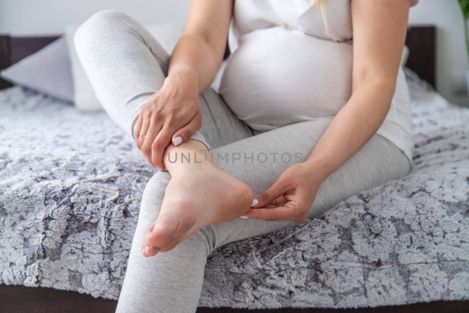 Pregnant woman legs are swollen. Selective focus. by Anuta23