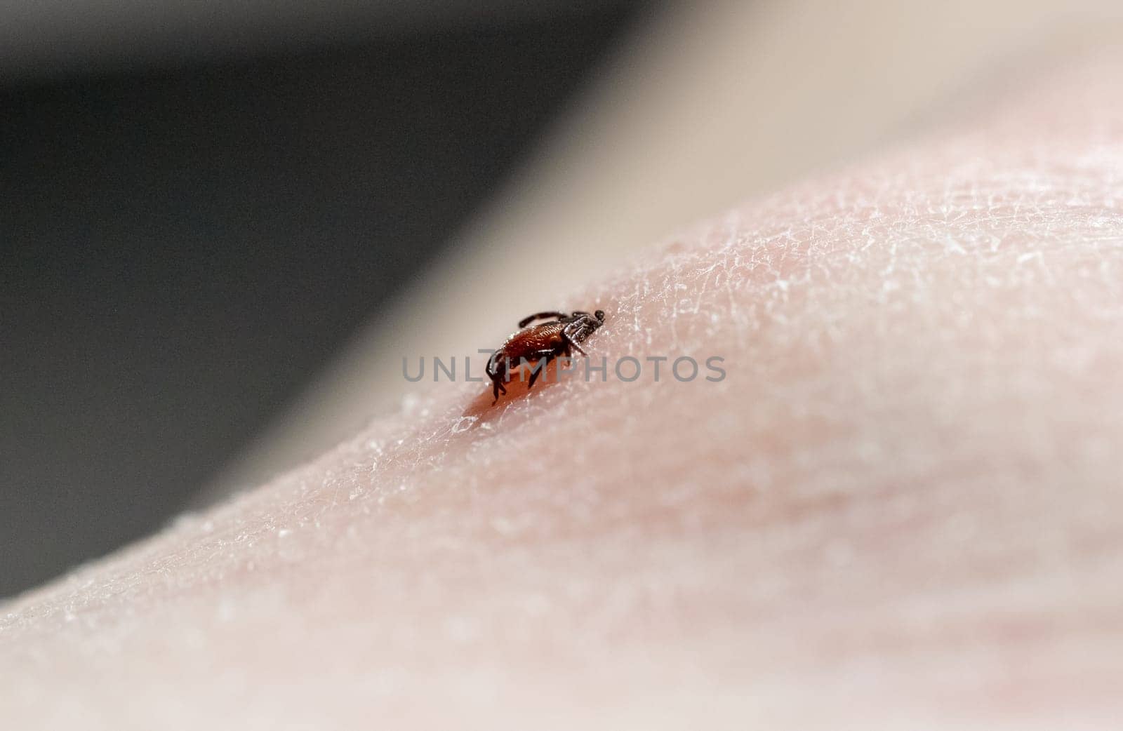 One small tick burrowed into the skin of a Caucasian man on the leg on a summer day, close-up side view.