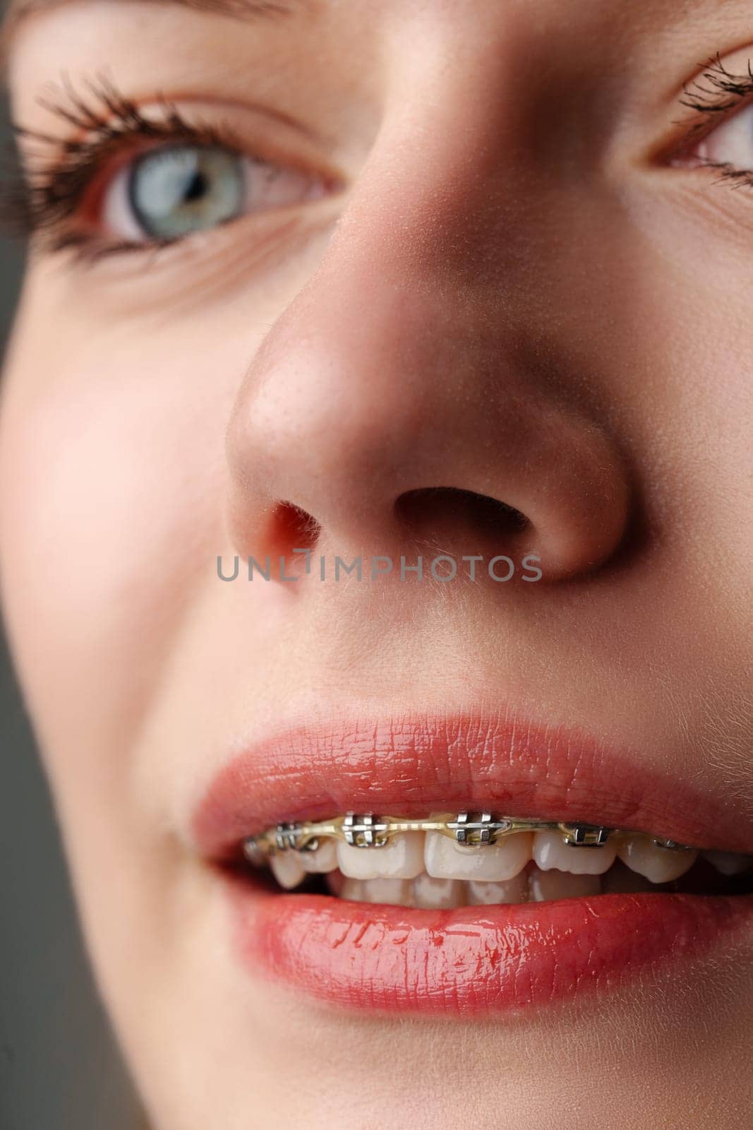 Young woman with dental braces close up by Fabrikasimf