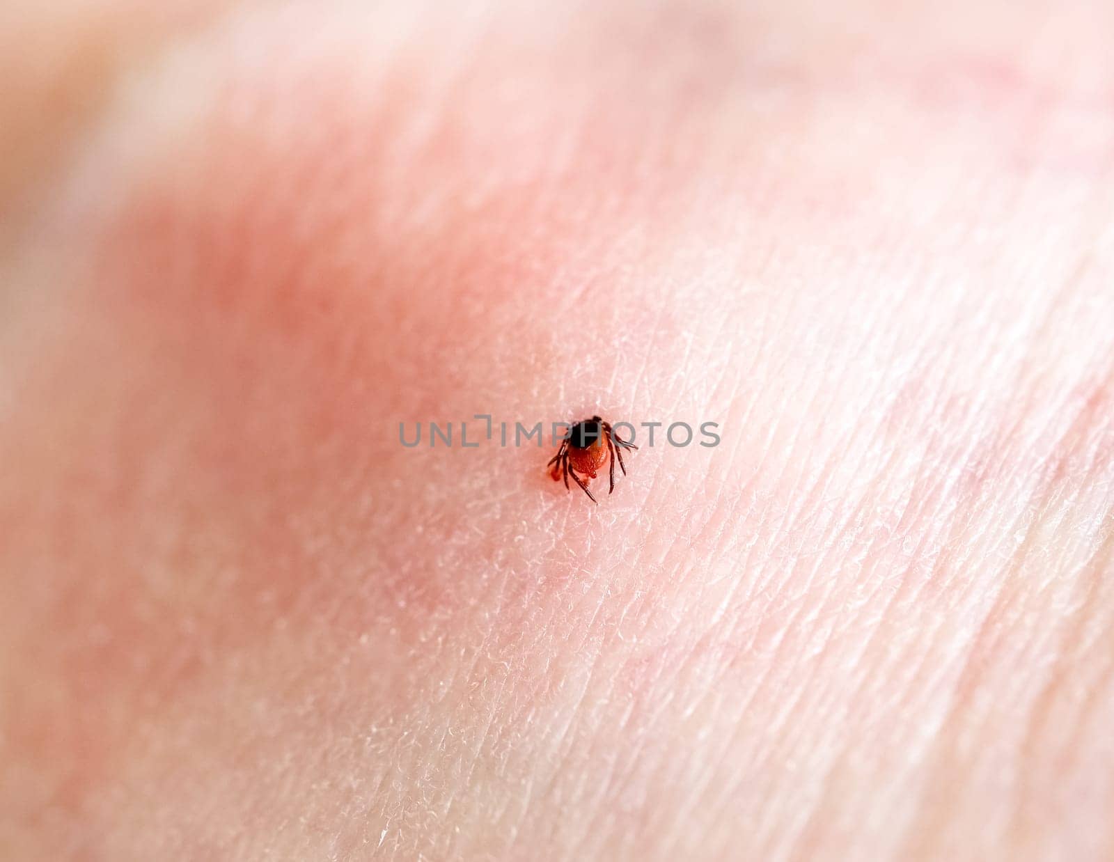 A tick embedded in a person skin. by Nataliya