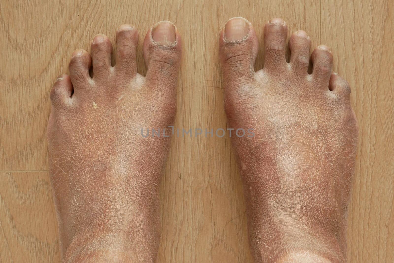 Closeup view of dry human feet skin . by towfiq007