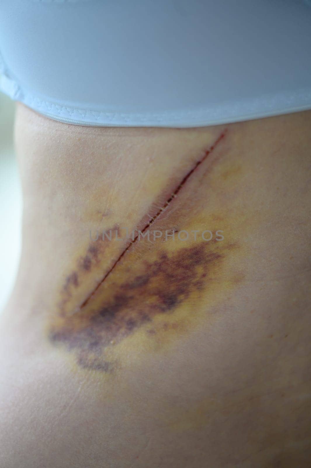 Close-up of a hematoma on a woman's back. 1 by Mixa74