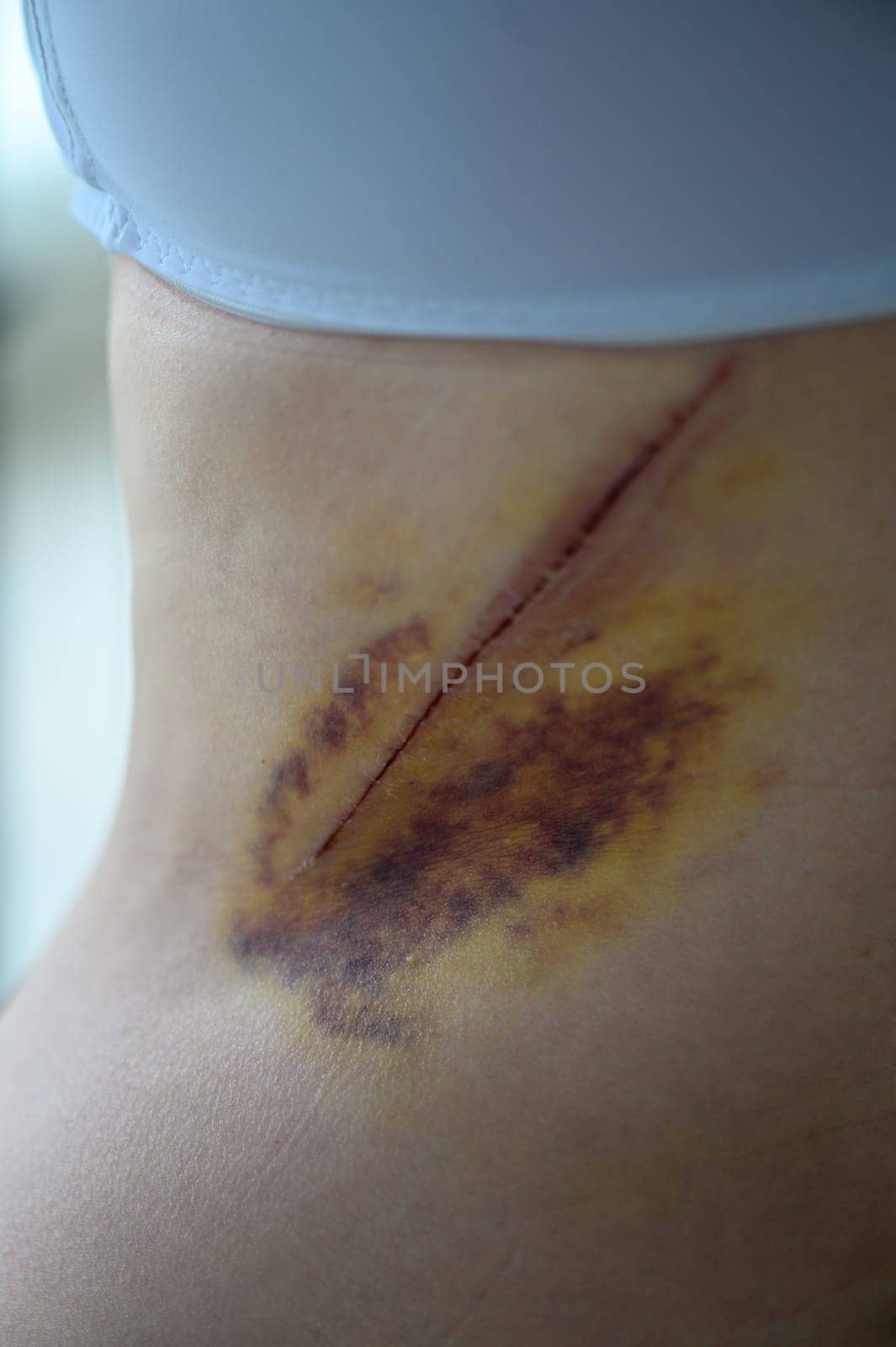 Close-up of a bruise on the wounded skin of a woman's back. 3 by Mixa74