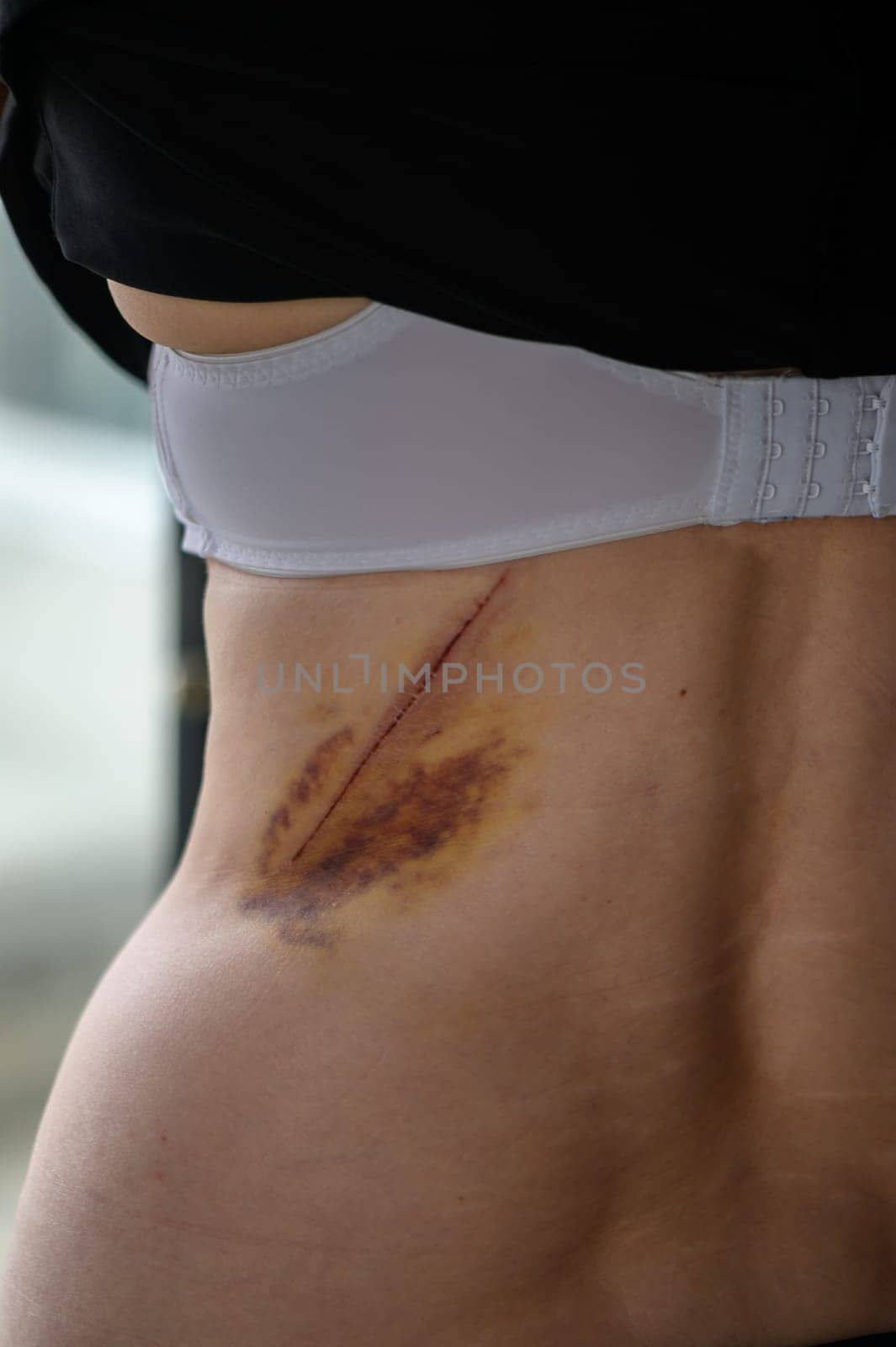 Close-up of a hematoma on a woman's back.