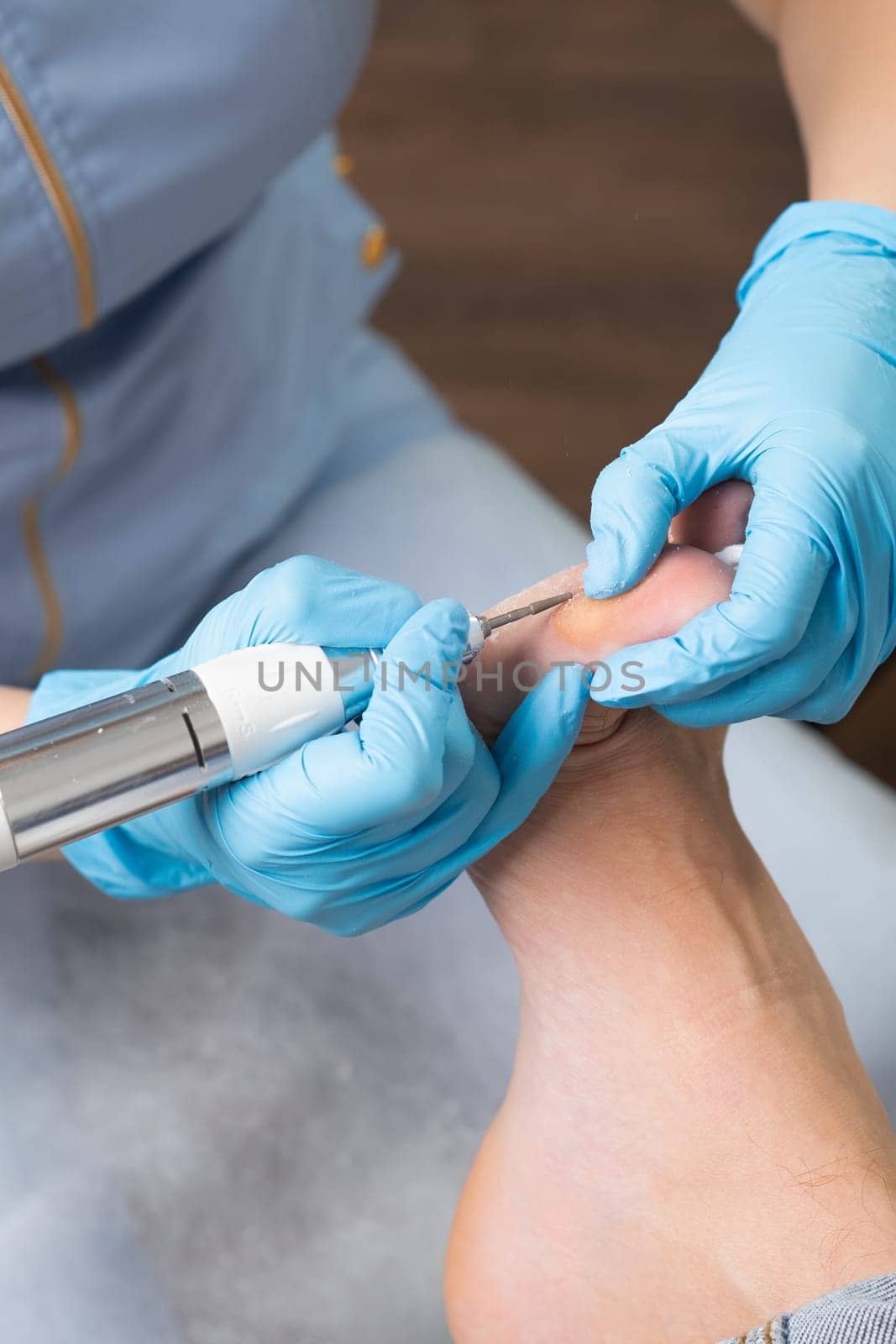 Podiatrist employs an electric drill to remove a callus from a womans foot