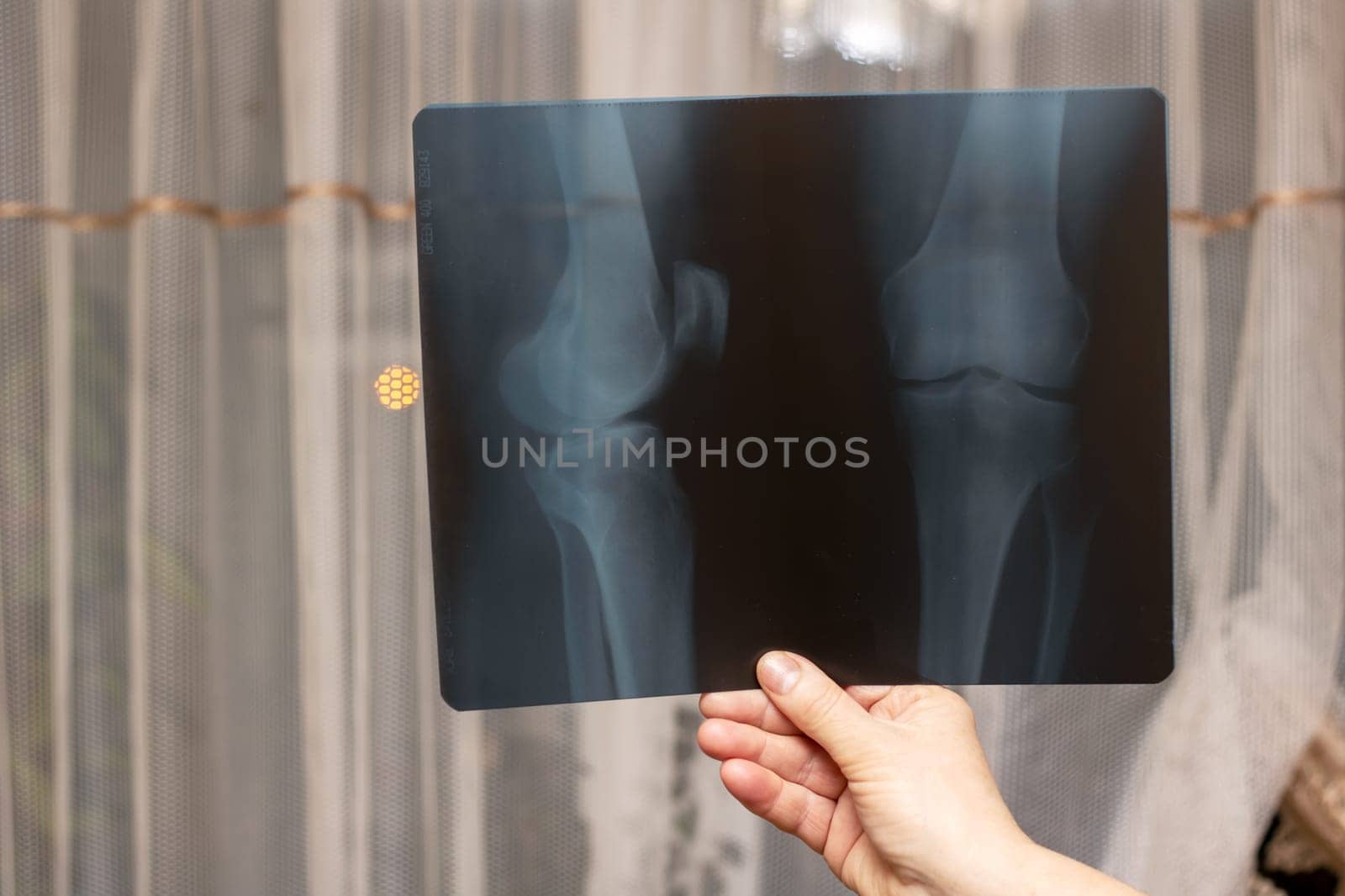 A person is holding an xray of their pelvis, examining the intricate tints and shades in the electric blue hues, creating a captivating visual arts gesture